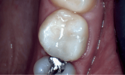 After treatment - Composite Filling
