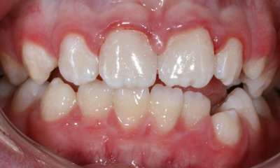After treatment - Cosmetic Dental Bonding