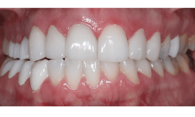After treatment - Crowns and Veneers Smile Restoration