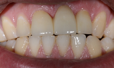 After treatment - Dental Bridge