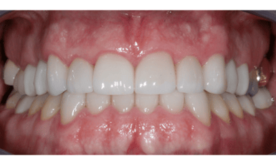 After treatment - Veneers, Dental Implant, and Crowns