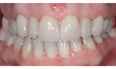 After treatment - Veneers and Teeth Whitening