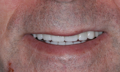 After treatment - Veneers