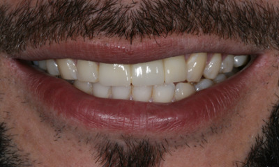 After treatment - Dental Bridge