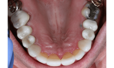 After treatment - Veneers, Dental Implant, and Crowns