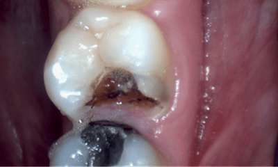 Before treatment - Composite Filling