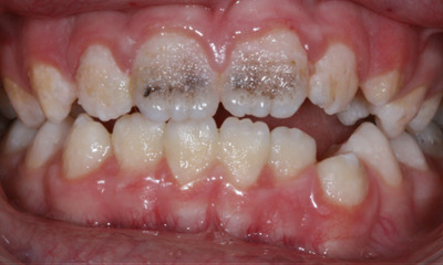 Before treatment - Cosmetic Dental Bonding