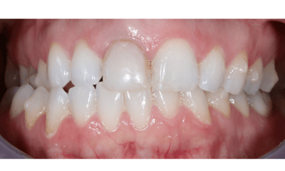 Before treatment - Crowns and Veneers Smile Restoration