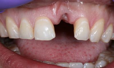 Before treatment - Dental Bridge