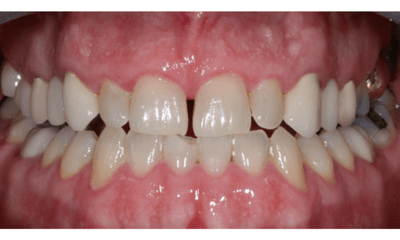 Before treatment - Veneers, Dental Implant, and Crowns