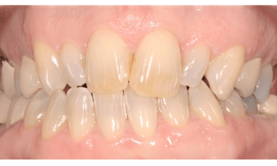 Before treatment - Veneers and Teeth Whitening
