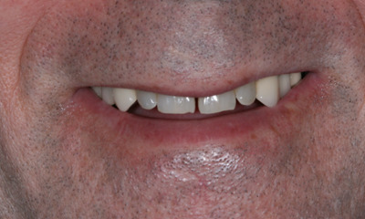 Before treatment - Veneers