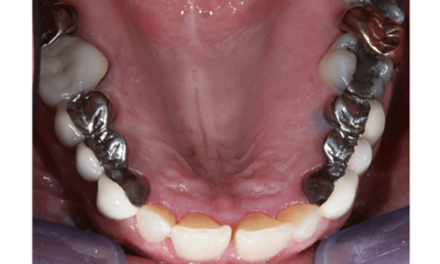 Before treatment - Veneers, Dental Implant, and Crowns