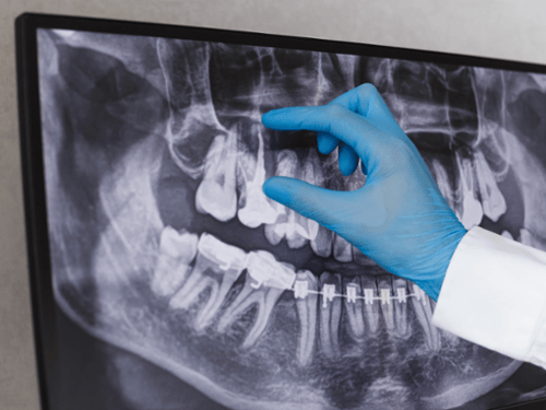 Panoramic X-Rays