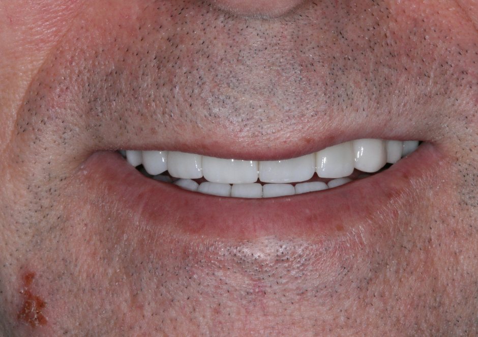 Riverfront Dental smile gallery â Veneers, after treatment