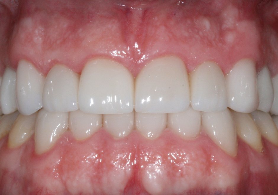 Riverfront Dental smile gallery â Veneers, implants and crowns, after treatment