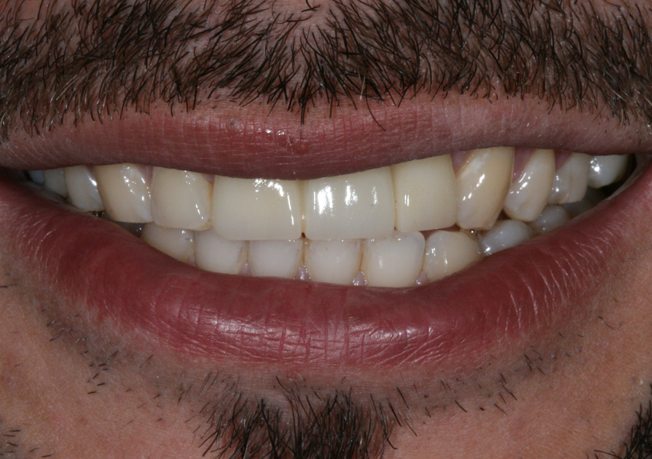 Riverfront Dental smile gallery â Bridge, after treatment