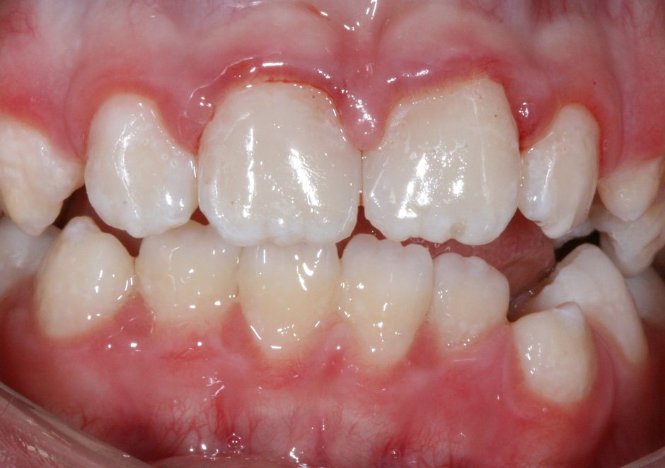 Riverfront Dental smile gallery â Cosmetic bonding, after treatment