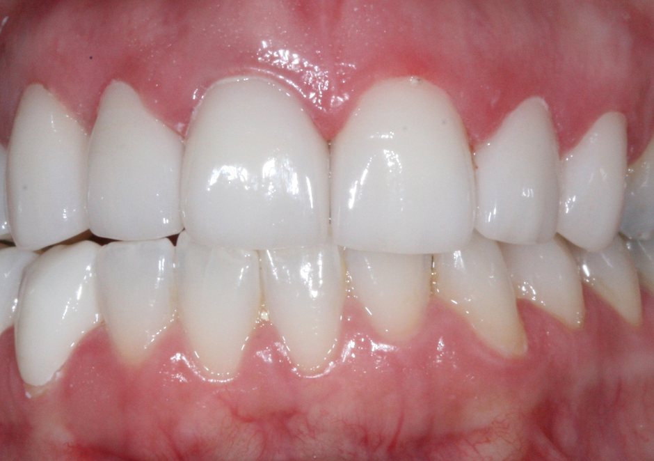 Riverfront Dental smile gallery â Crowns and veneers, after treatment
