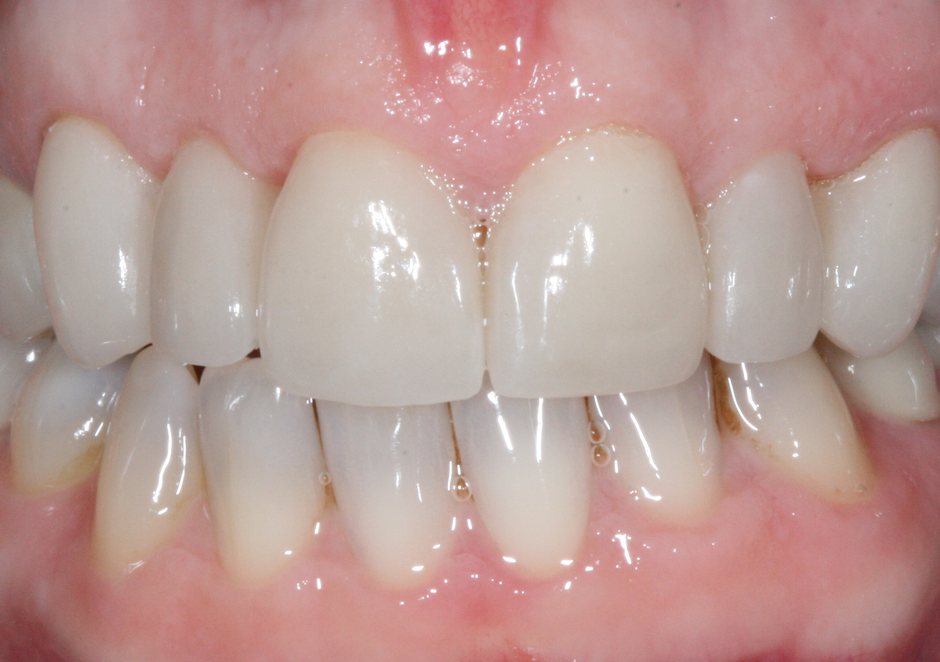 Riverfront Dental smile gallery â Veneers and whitening, after treatment