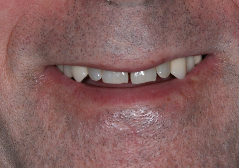 Riverfront Dental smile gallery â Veneers, before treatment