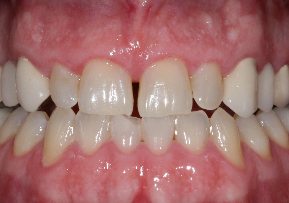Riverfront Dental smile gallery â Veneers, implants and crowns, before treatment