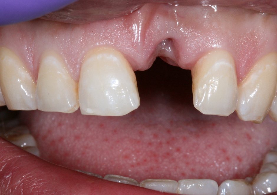 Riverfront Dental smile gallery â Bridge, before treatment
