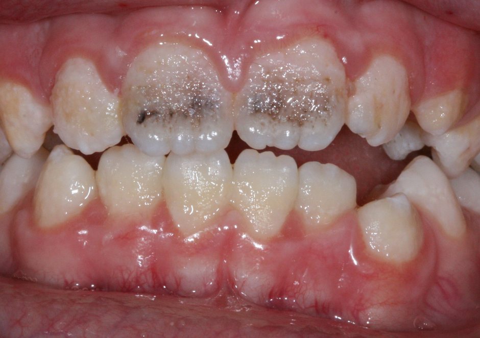 Riverfront Dental smile gallery â Cosmetic bonding, before treatment