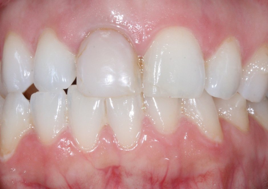 Riverfront Dental smile gallery â Crowns and veneers, before treatment
