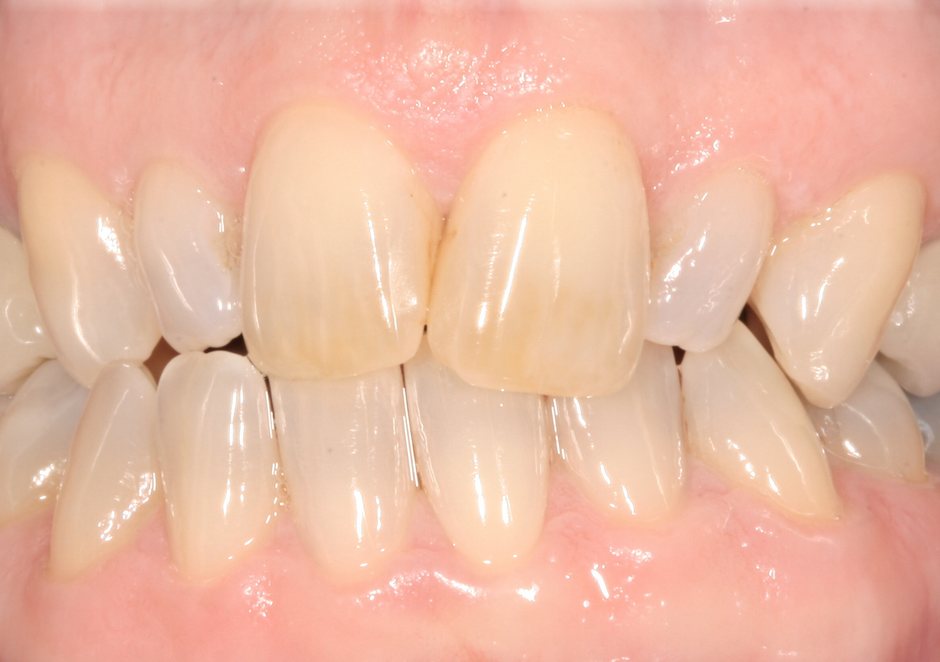 Riverfront Dental smile gallery â Veneers and whitening, before treatment
